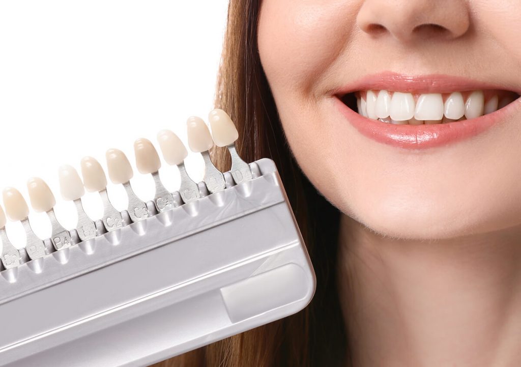 Porcelain Veneers for Teeth Ontario CA - Dental Veneers ...