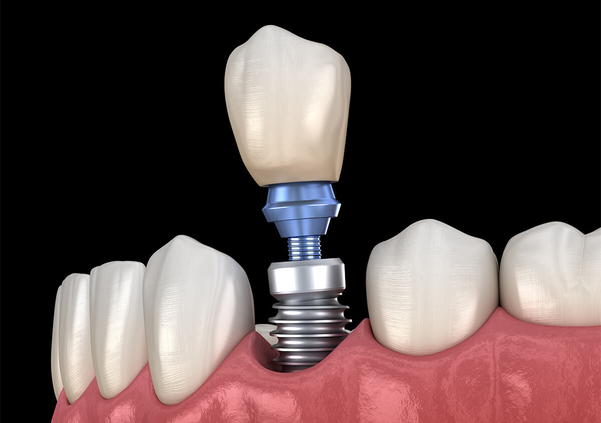 Dentist for Teeth Implants in Ontario CA Area