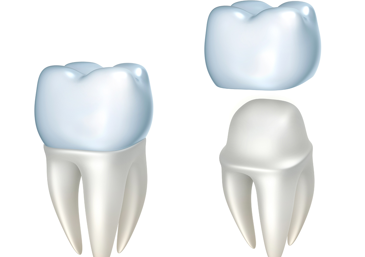 Cerec Dental Crowns in Ontario CA Area