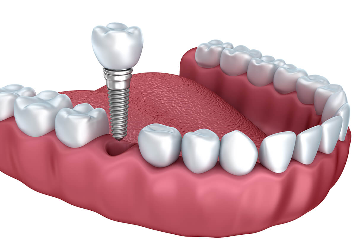 Implants for Teeth in Ontario CA Area